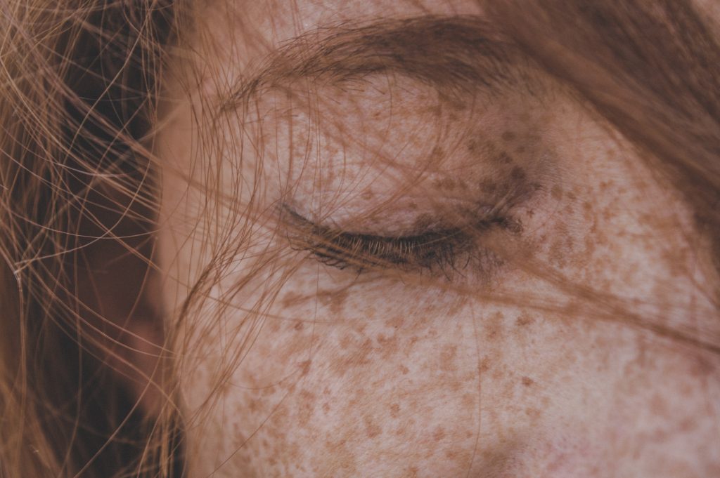 hyperpigmentation